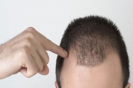 محلول تقویت کننده و ضد ریزش مو و تحریک پیاز مو - 1