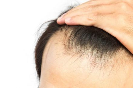درمان ریزش مو و افزایش رویش مجدد با گیت پی - 1