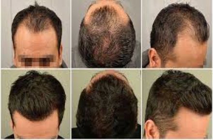 تونیک ضدریزش مو و تحریک کننده رشد مو - 1