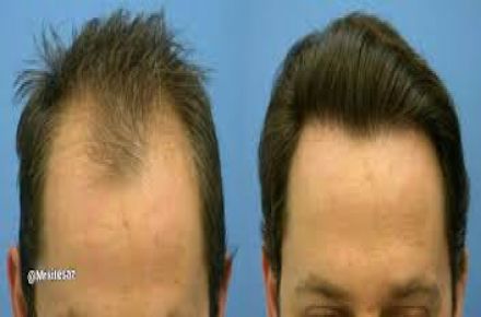 شامپو تقویت کننده رشد موی سر لدورا - 1