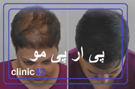 جوانسازی صورت و درمان ریزش مو با PRP - 1
