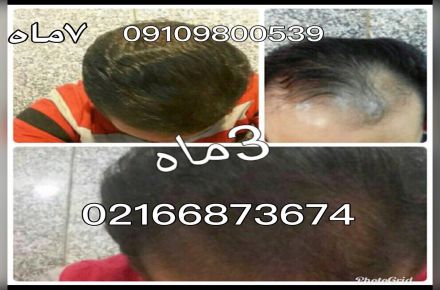 درمان قطعی ریزش مو با لاناریا - 1