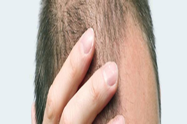 تاثیر هورمون ها بر رشد و ریزش مو